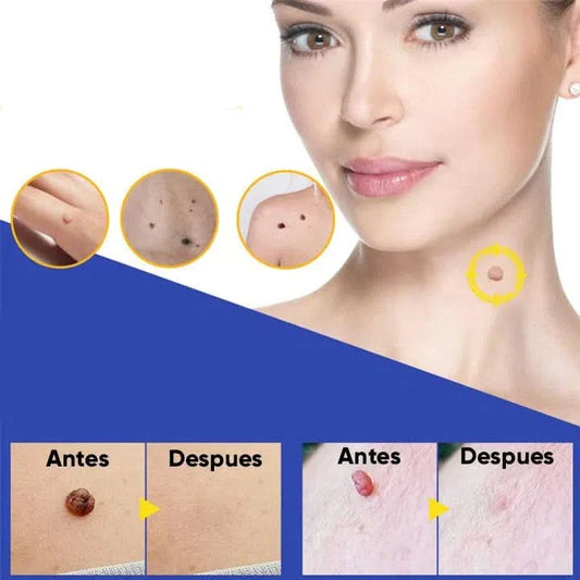 Kit de Eliminación de Verrugas 40 Piezas
